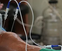 고주파 열 치료술, 인공관절 수술 후 통증 개선 도와