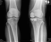 자기관절 보존하는 ‘인공관절 부분치환술’...정밀한 삽입 위치 선정 중요