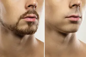 모(毛)자람 없는 ‘그루밍족’에, 남성 레이저 제모 인기