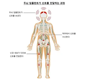 두뇌 임플란트로 생각만으로 걷는다