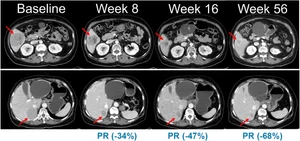 한미약품, 흑색종 신약 ‘벨바라페닙’ 임상 2상 환자 투약 개시