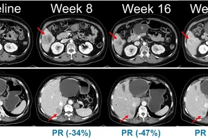 한미약품, 흑색종 신약 ‘벨바라페닙’ 임상 2상 환자 투약 개시