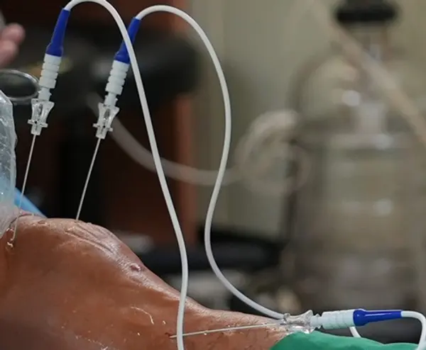 수술 후 통증 완화를 돕는 고주파 열 치료술