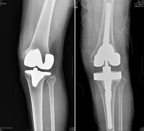  인공관절 재치환술 전 후 외상으로 인해 축이 비뚤어졌던 무릎이 바로 잡혔다.