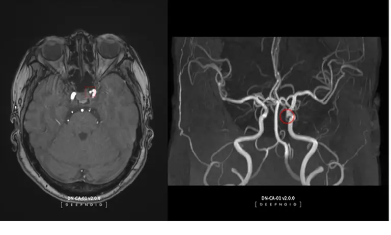 딥노이드의 뇌동맥류 뇌영상검출·진단보조소프트웨어 
