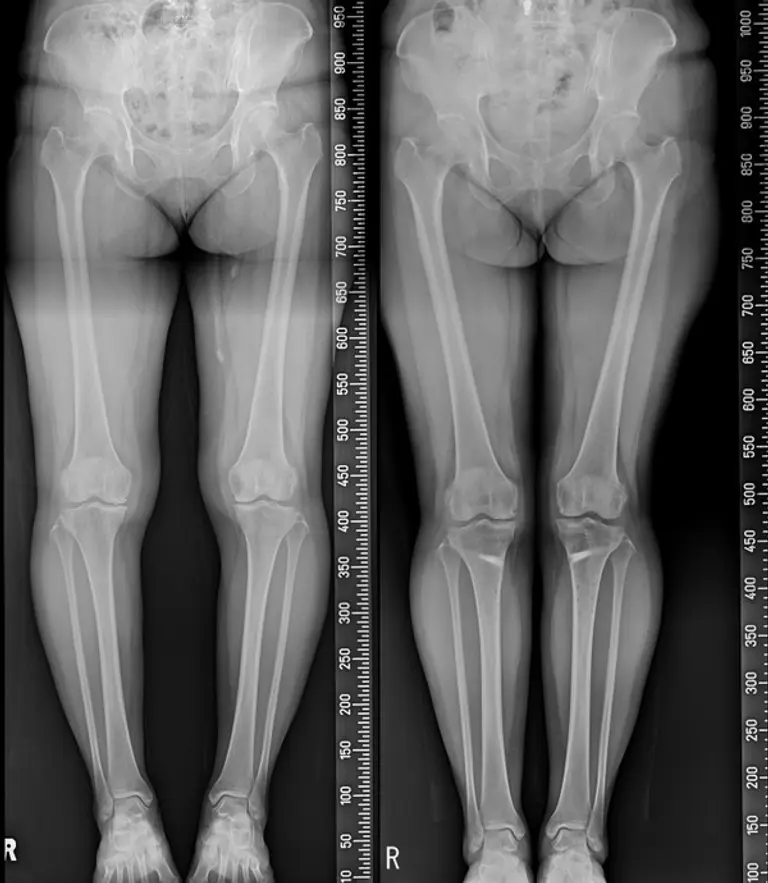 51세 여성 절골술+줄기세포 치료 전 후, 휘었던 다리가 곧아졌다