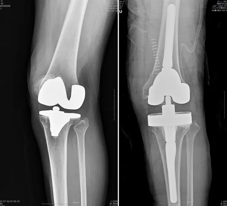  인공관절 재치환술 전 후 외상으로 인해 축이 비뚤어졌던 무릎이 바로 잡혔다.