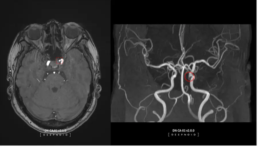 딥노이드의 뇌동맥류 뇌영상검출·진단보조소프트웨어 '딥뉴로(DEEP:NEURO)'가 지난 14일 한국보건의료연구원(NECA)의 최종 평가를 통해 혁신의료기술로 선정됐다. 이에 따라 딥노이드는 한시적 비급여 대상으로 임상시장 진입이 가능해졌다.
