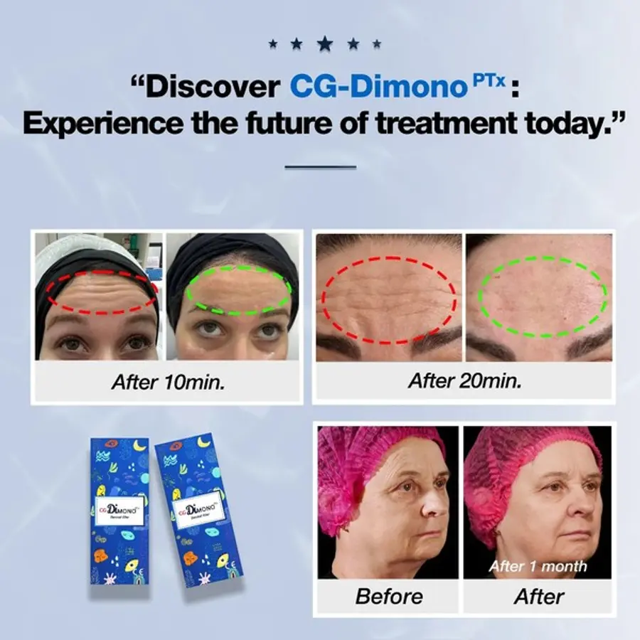 케어젠 인스타그램. 디모노PTx는 시술 20분 뒤 확연한 효과를 볼 수 있는 필러 제품이라고 소개하고 있다. 