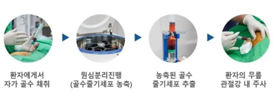골수 흡인물 무릎주사 치료 과정 [출처: 금융감독원]