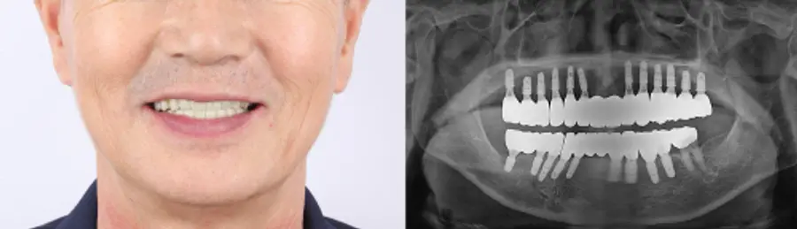 의식하 진정법을 적용한 환자의 X레이 사진(오른쪽) [사진 제공: 서울서이치과]