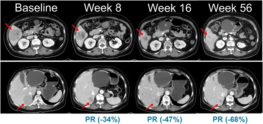 NRAS 돌연변이 흑색종 환자를 대상으로 진행된 벨바라페닙과 코비메티닙 병용요법 임상시험에서 시간 경과에 따른 병변 변화가 관찰된 복부 CT 영상. (출처: 미국임상종양학회(ASCO) 2021 구연 발표)